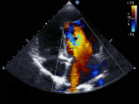 stress echocardiogram results|Stress Echo Test Results: Understanding What They Mean.